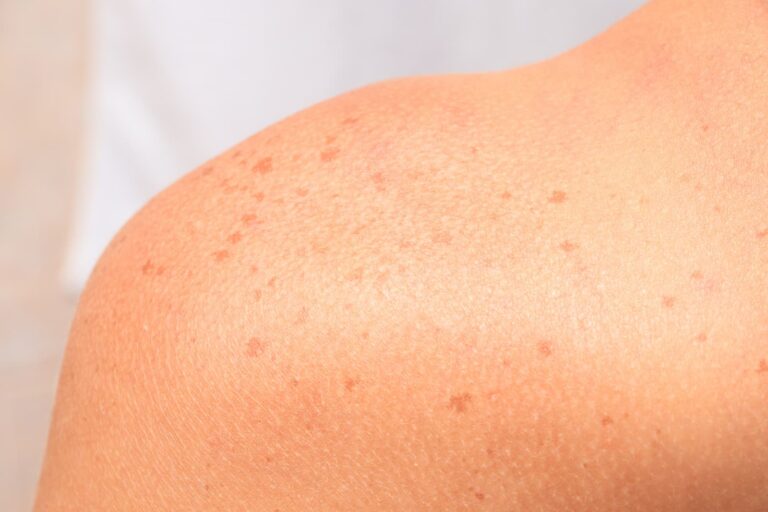 woman has sun spot freckles on her skin