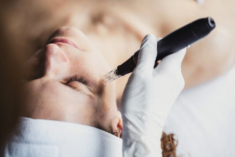 micro needling