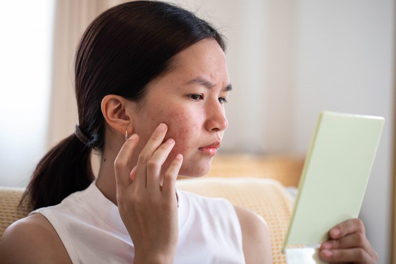 Acne Scars?  Here Are the 4 Best Treatments We Recommend!