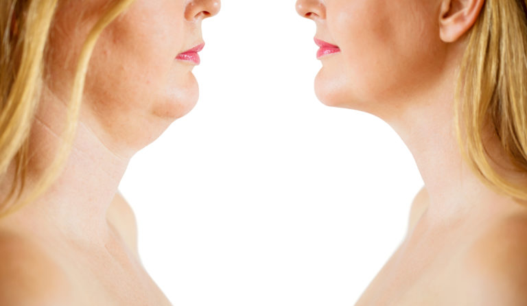 Kybella before and after